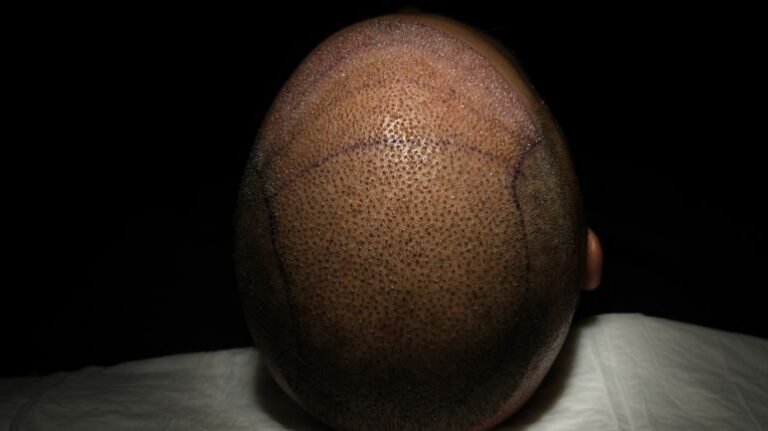 Home 42 FUE Specialized for Afro Hair Transplants