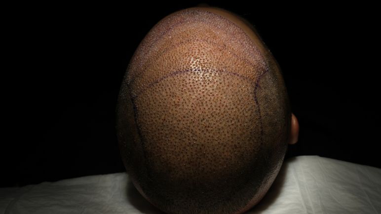 Home 6 FUE Specialized for Afro Hair Transplants
