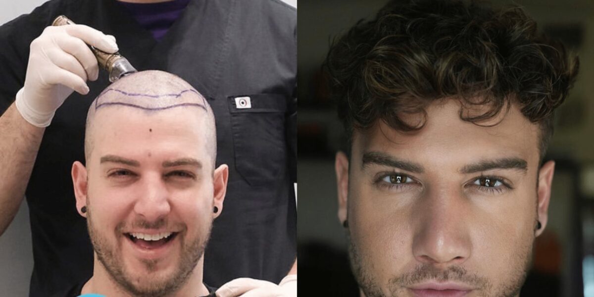 Your Hair Transplant Journey: What to Expect After the Procedure