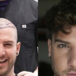 Before after hair transplant