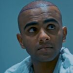 hair transplant measurement procedure