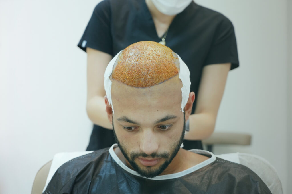 Home 5 hair transplant measurement procedure