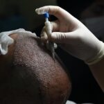 DHI Hair Transplant Technique: Everything You Need to Know