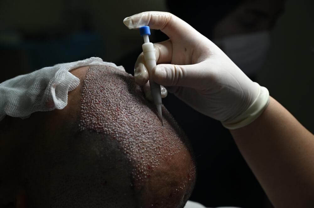 The DHI Hair Transplant Technique: Everything You Need to Know