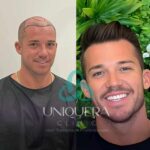 Before-and-After-Hair-Transplant-Real-Results-from-Real-Patients