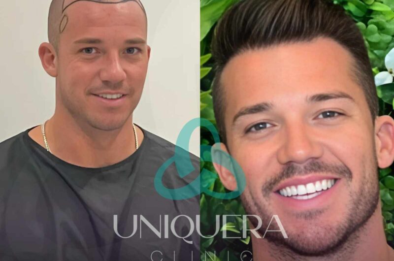 Why More Americans Choose Turkey for Hair Transplants in 2025