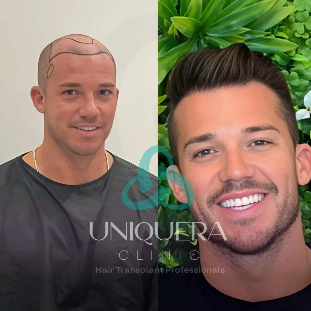 Why More Americans Choose Turkey for Hair Transplants in 2025 1 Before and After Hair Transplant Real Results from Real Patients