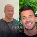 Before and After Hair Transplant: Real Results from Real Patients