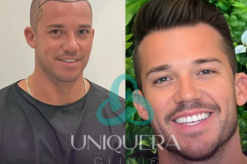 Why More Americans Choose Turkey for Hair Transplants in 2025