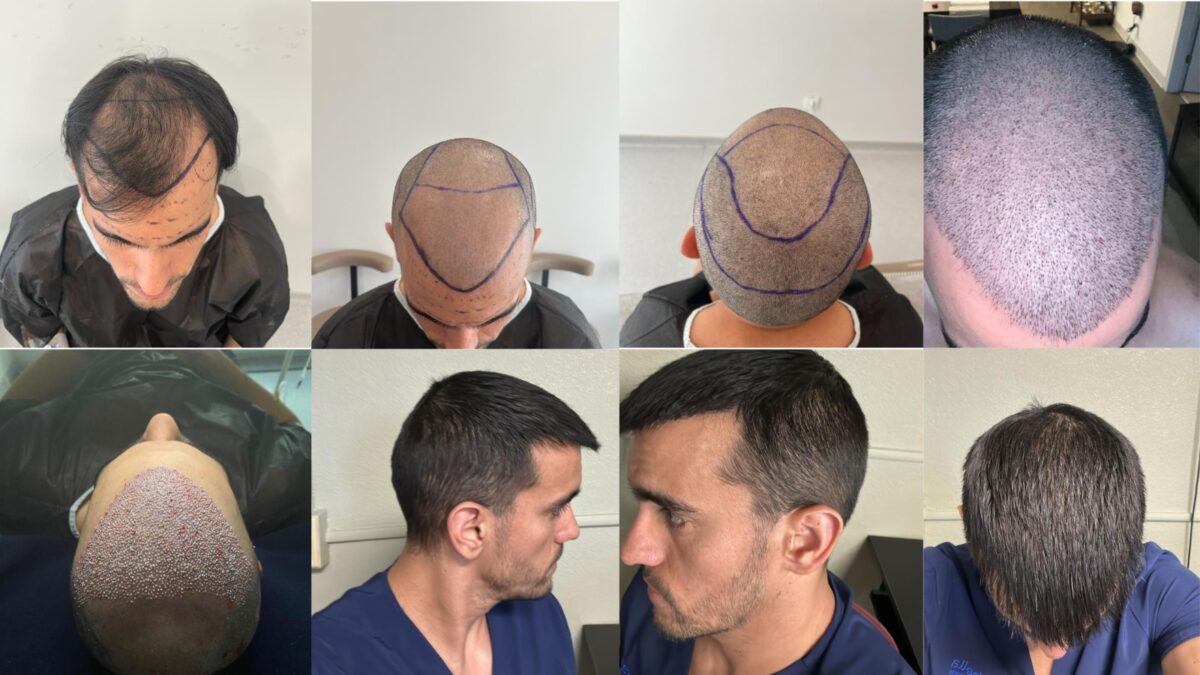 DHI Hair Transplant in Turkey – Cost 2025: What’s Included and Why It’s Worth the Hype