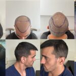 DHI Hair Transplant in Turkey – Cost 2025