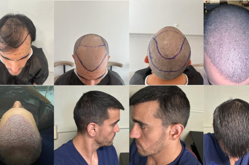 DHI Hair Transplant in Turkey – Cost 2025: What’s Included and Why It’s Worth the Hype