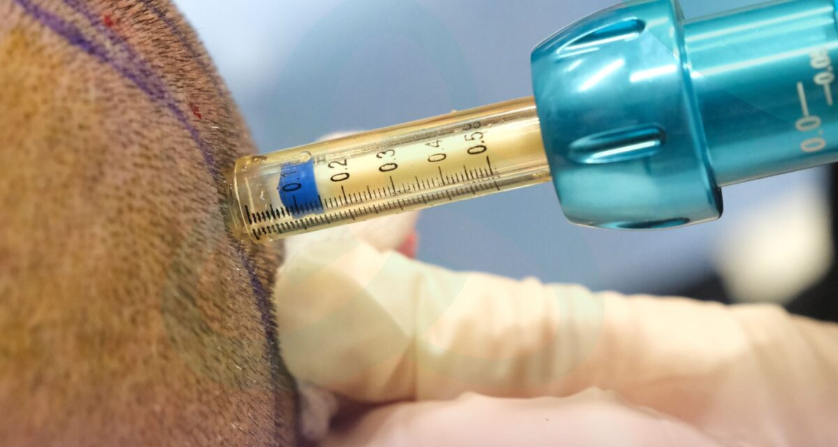 Understanding Hair Transplant Anaesthesia: Your Guide at UniquEra Clinic