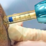 Hair Transplant Anaesthesia