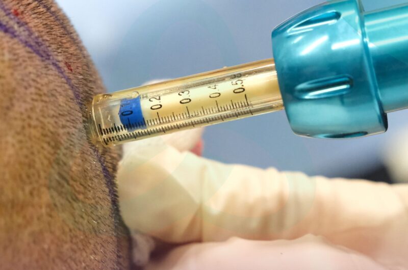 Understanding Hair Transplant Anaesthesia: Your Guide at UniquEra Clinic