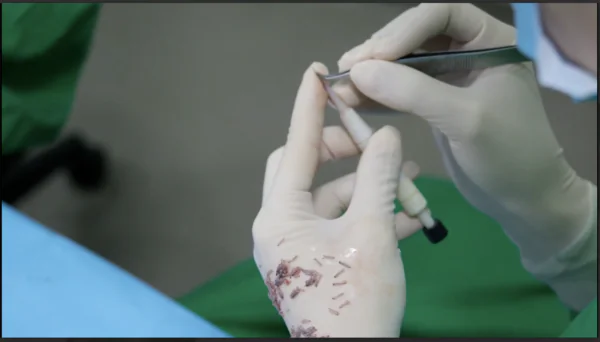 Graft Extraction