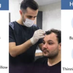 Hair Loss Is Not Always Normal: Understanding Shedding Signals