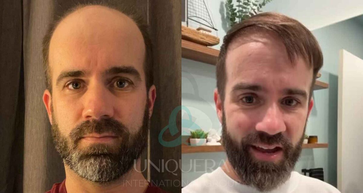 Invest in Yourself: How a Hair Transplant Can Improve the Quality of Your Life