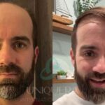 How a Hair Transplant Can Improve the Quality of Your Life