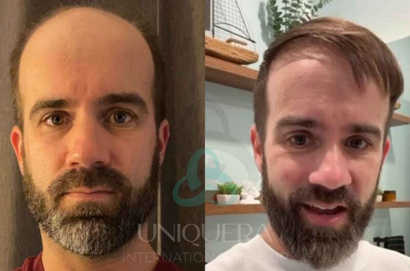 Invest in Yourself: How a Hair Transplant Can Improve the Quality of Your Life