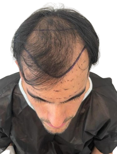 New VIP 1 Before treatment