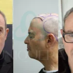 Hair Transplant Techniques