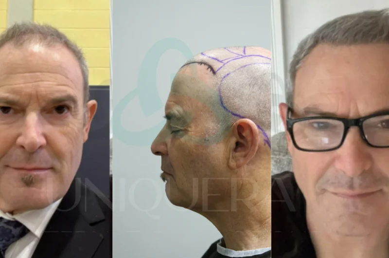 Best Hair Transplant Techniques for the Different Types of Hair Loss