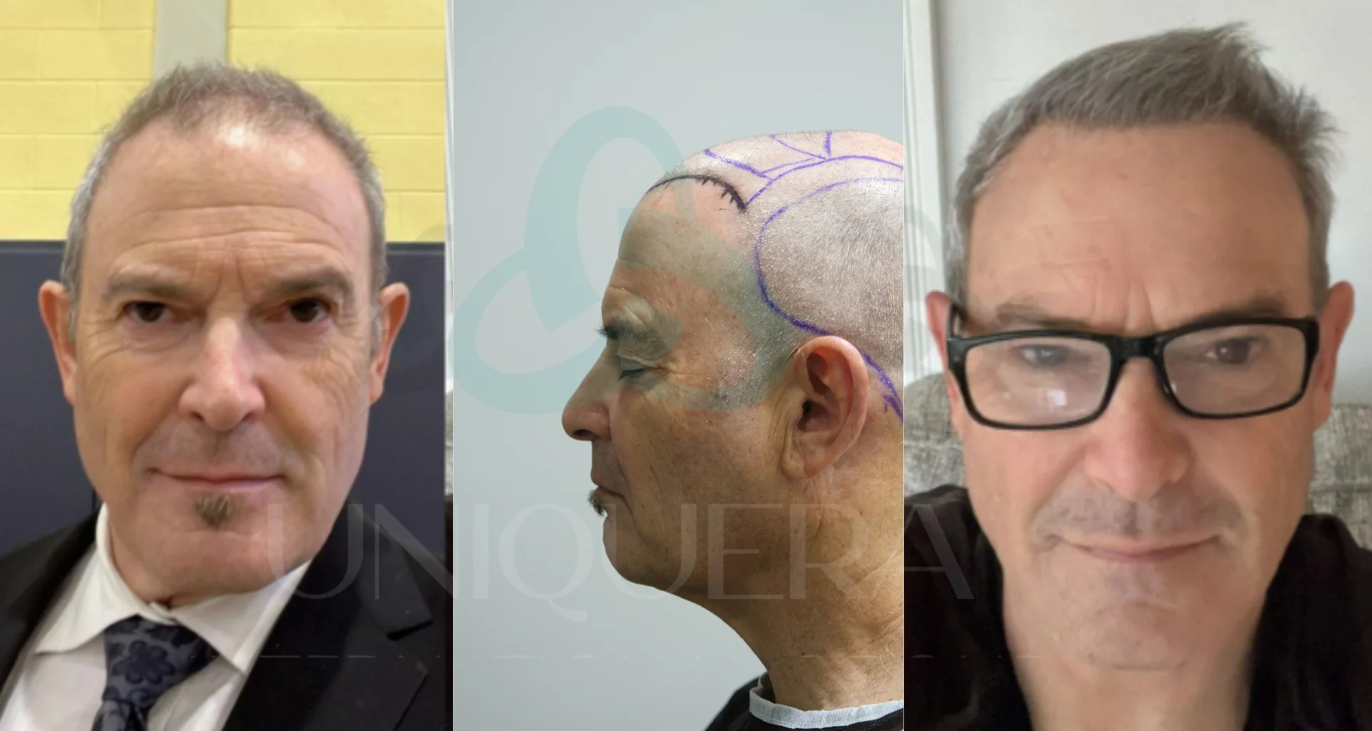 Best Hair Transplant Techniques for the Different Types of Hair Loss