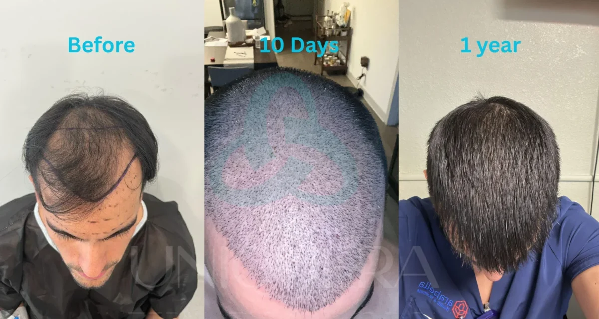 How Long Does a Hair Transplant Last? Know What Experts Say