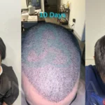 How Long Does a Hair Transplant Last