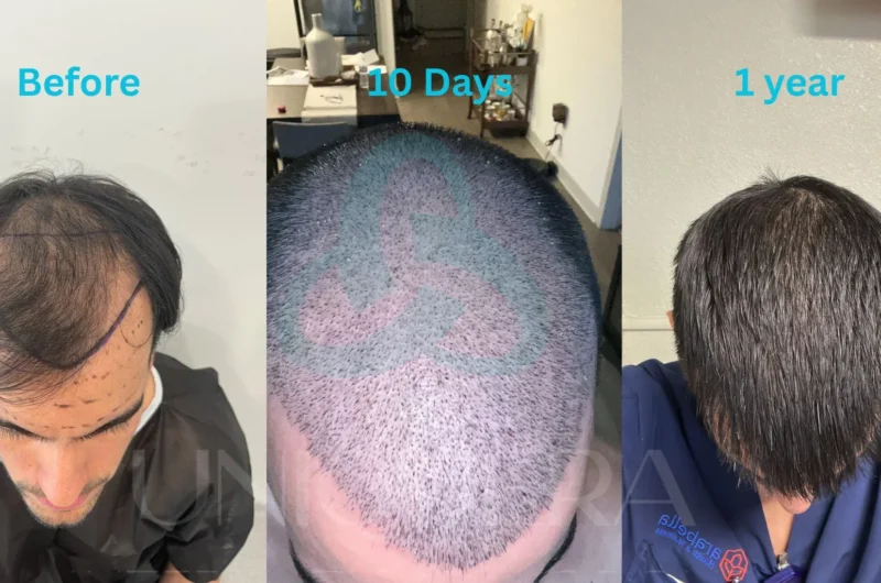 How Long Does a Hair Transplant Last? Know What Experts Say