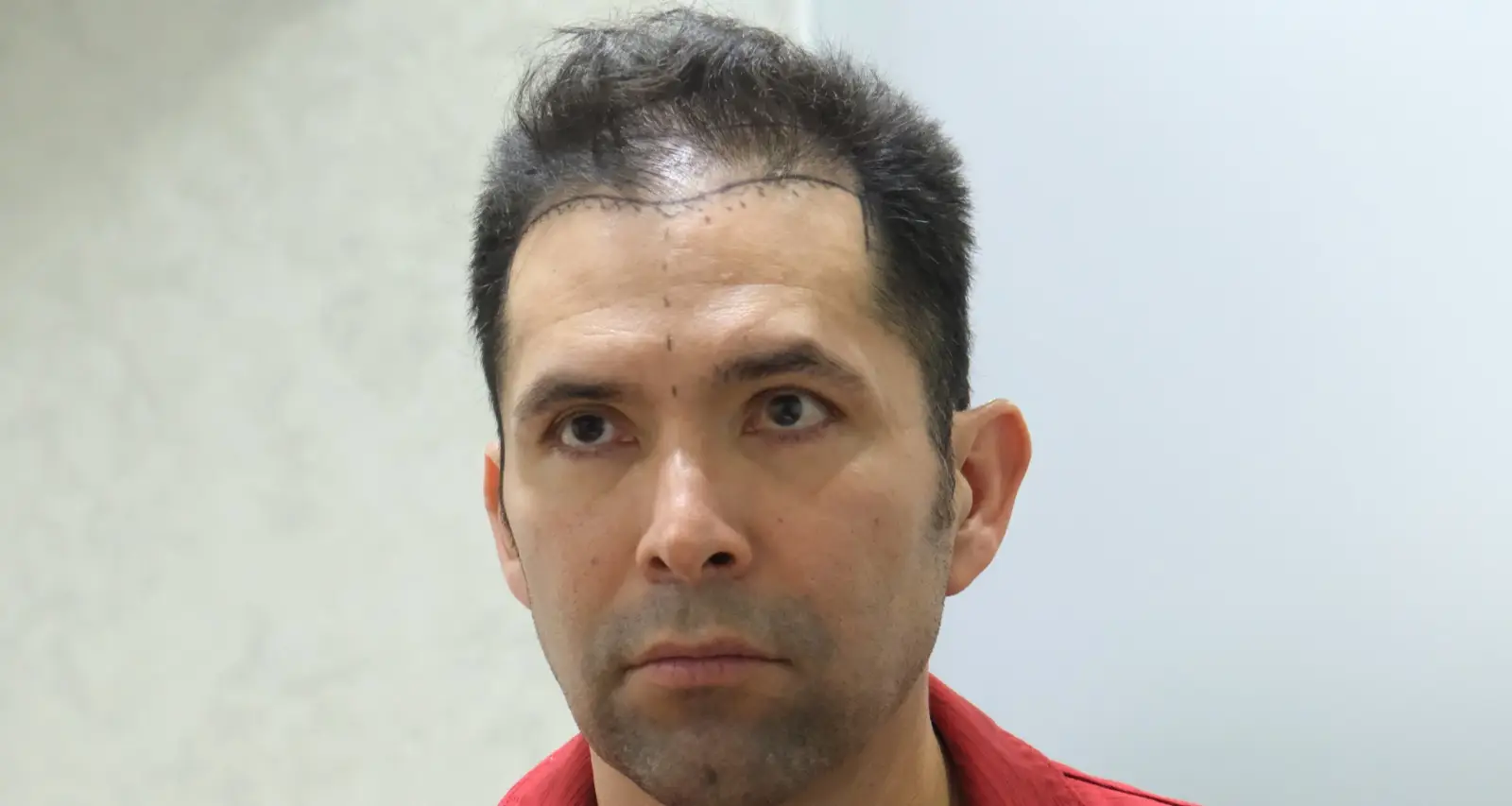 Hair Thinning: What’s Really Happening and What Solutions We Offer at UniquEra Clinic