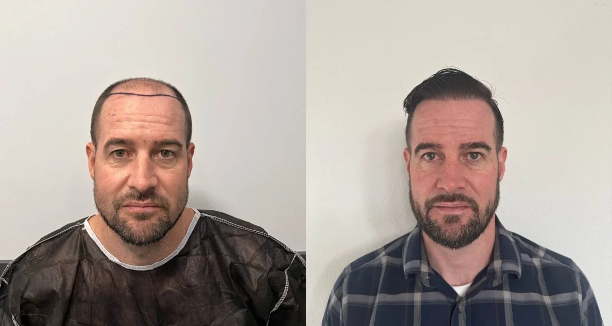 Hair Transplant Process: Everything You Need to Know