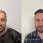 Hair-Transplant-Process_uniquEra