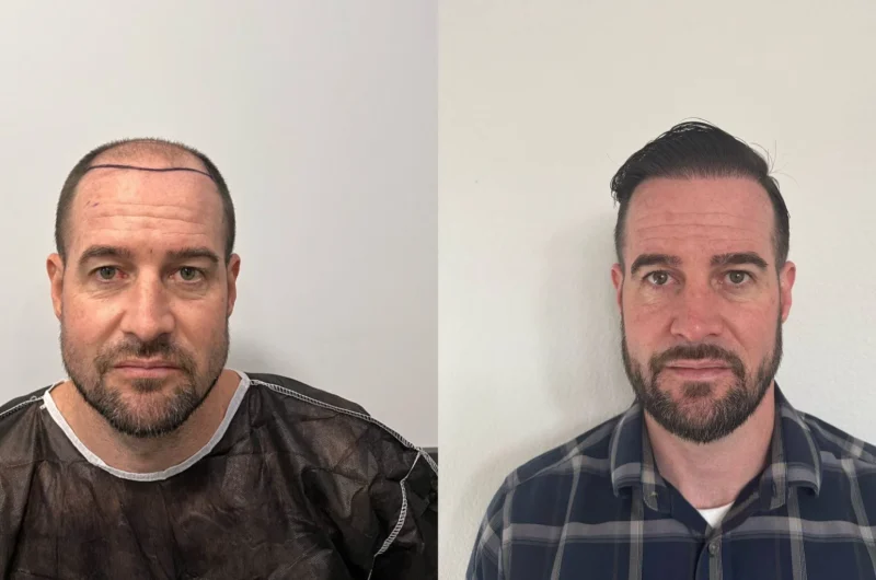 Hair Transplant Process: Everything You Need to Know