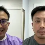 Hair Transplant in Turkey - UniquEra