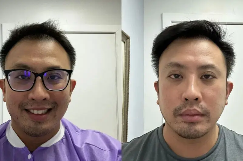 Should You Get a Hair Transplant in Turkey? Know What Experts Say