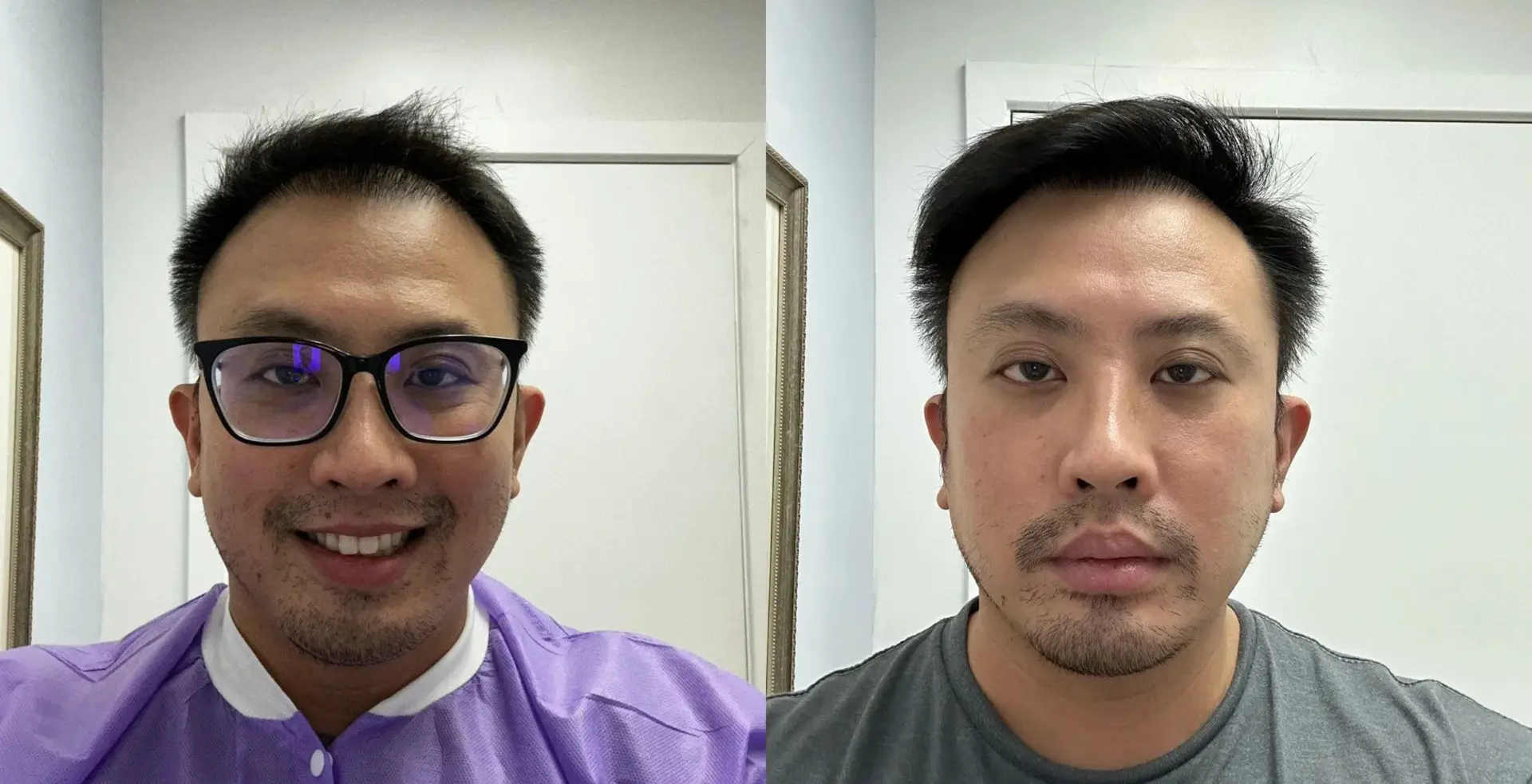 Should You Get a Hair Transplant in Turkey? Know What Experts Say