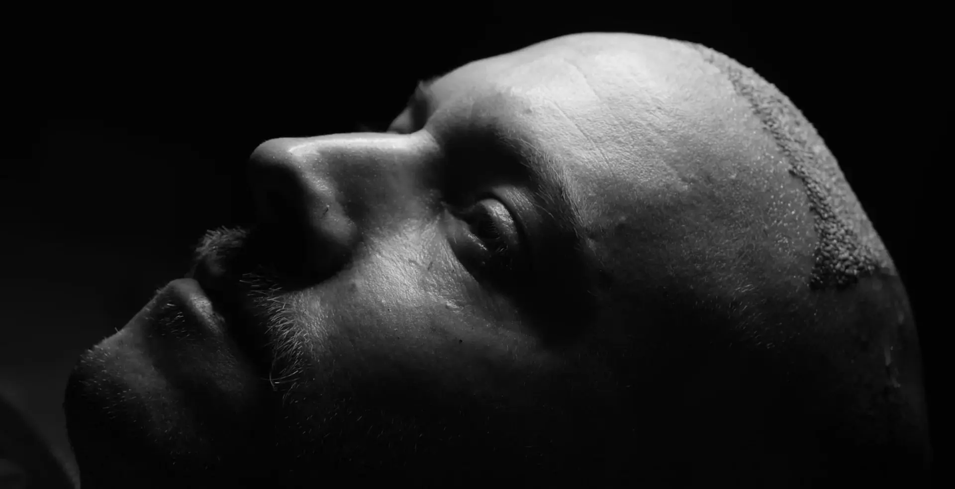 Side Effects After Hair Transplant: Why You Should Pick UniquEra Clinic