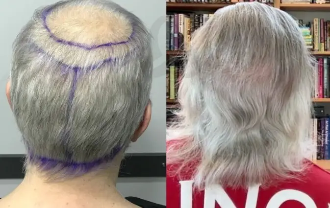  crown hair transplant before and after