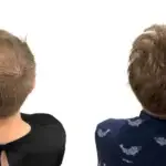 Crown Hair Transplant