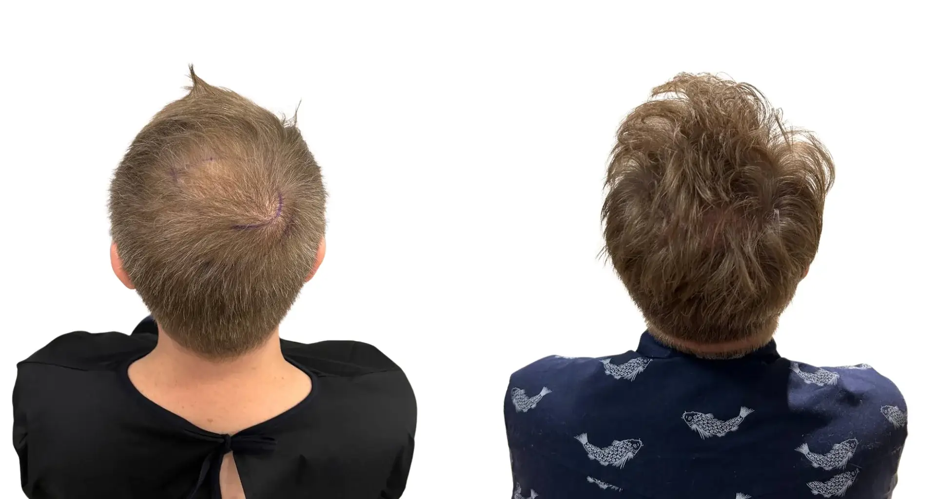 Crown Hair Transplant in Turkey – Your Complete Guide