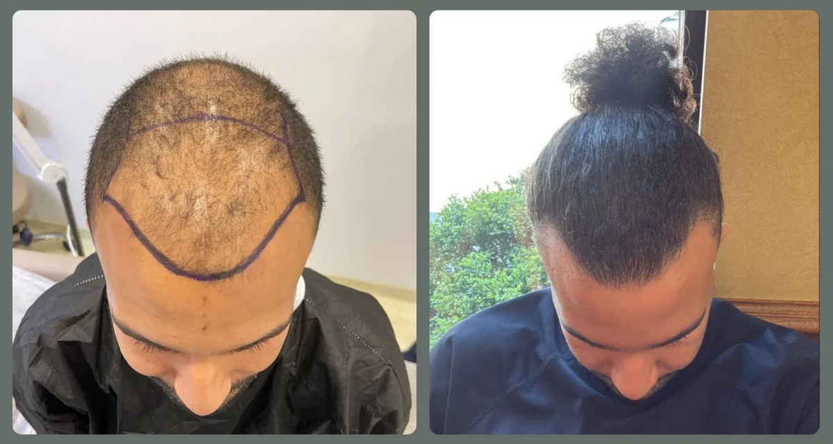 Afro Hair Transplants in Turkey: Unique Challenges and Advanced Solutions