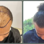 Afro Hair Transplants in Turkey_ UniqueEra_Clinic