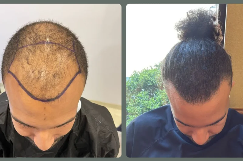 Afro Hair Transplants in Turkey: Unique Challenges and Advanced Solutions