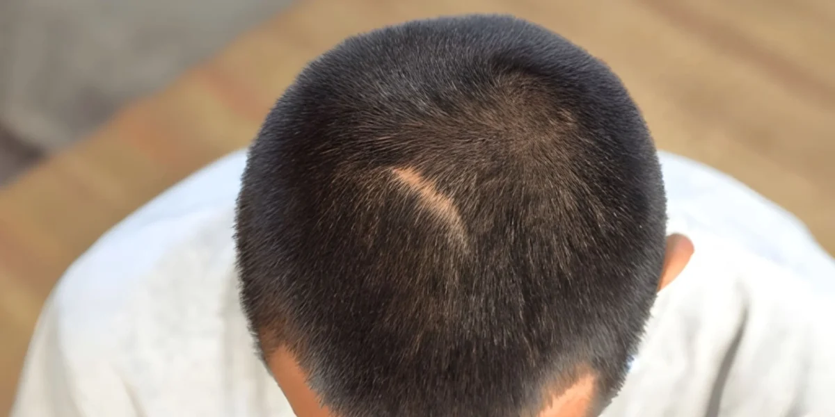 Fix Hair Transplant Scar: How to Restore Your Hair Growth on Scars