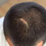 Fix Hair Transplant Scar_UniquEra_Clinic
