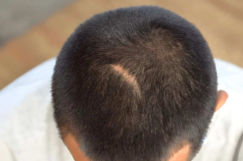 Fix Hair Transplant Scar: How to Restore Your Hair Growth on Scars