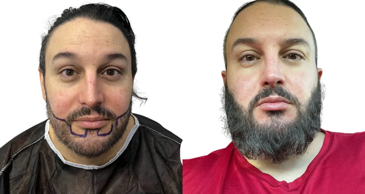 Patchy Beard Growth: How to Handle It