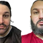 Patchy Beard Growth Treatment_UniquEra Clinic